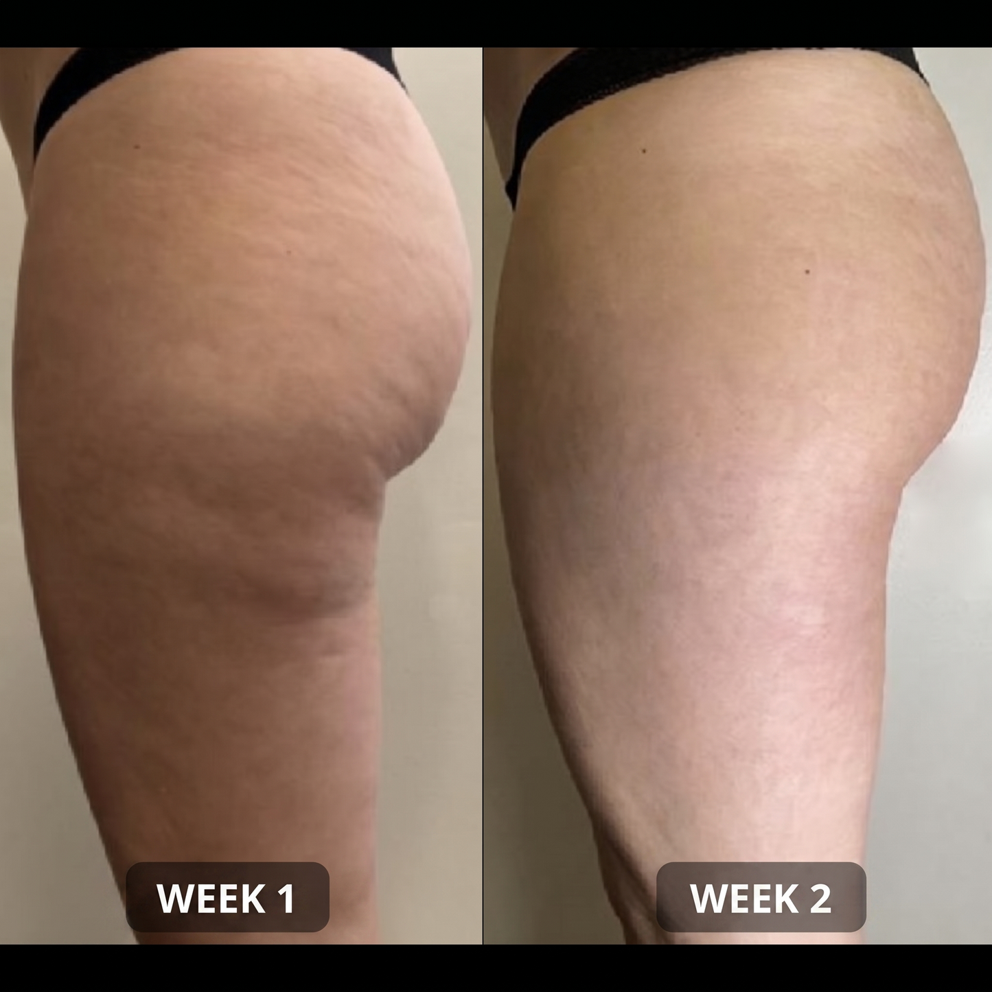 Anti-Cellulite Patches